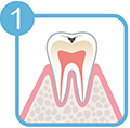 エナメル質のむし歯